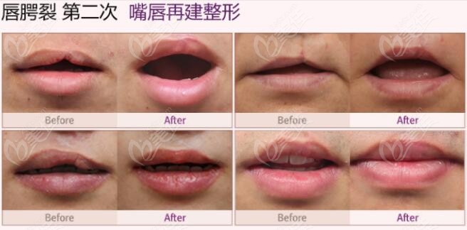 cleft lip repair cleft lip repair