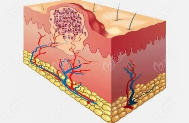 Injection scar removal technique Injection scar removal technique