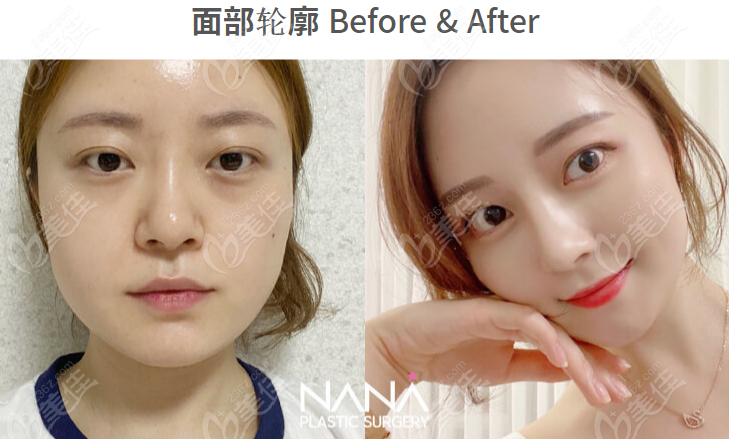 How is NANA Plastic Surgery's facial contouring? How is NANA Plastic Surgery's facial contouring?