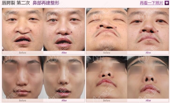 before and after cleft lip repair by MVP Plastic Surgery before and after cleft lip repair by MVP Plastic Surgery