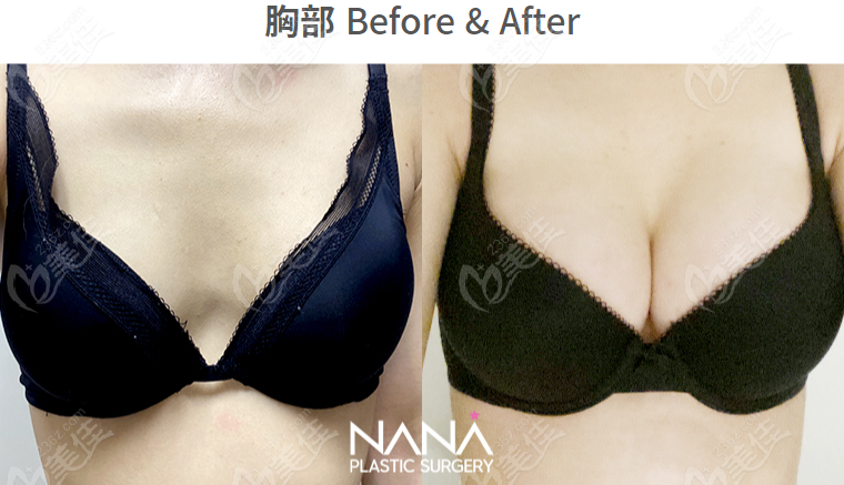 How is NANA Plastic Surgery's breast augmentation? How is NANA Plastic Surgery's breast augmentation?
