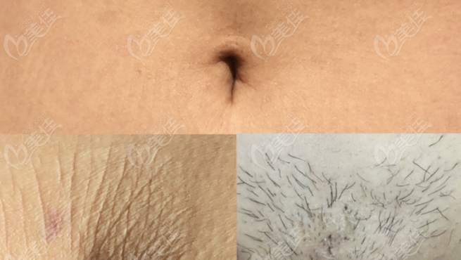 leave no visible scars leave no visible scars