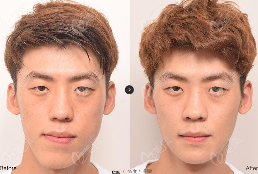 facial contouring facial contouring