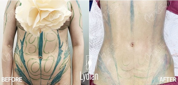 How is V-line Abdominal Liposuction Performed? How is V-line Abdominal Liposuction Performed?