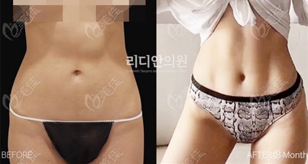 Advantages of Lydian Plastic Surgery's Liposculpture Advantages of Lydian Plastic Surgery's Liposculpture