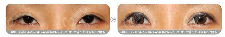 double eyelid repair double eyelid repair