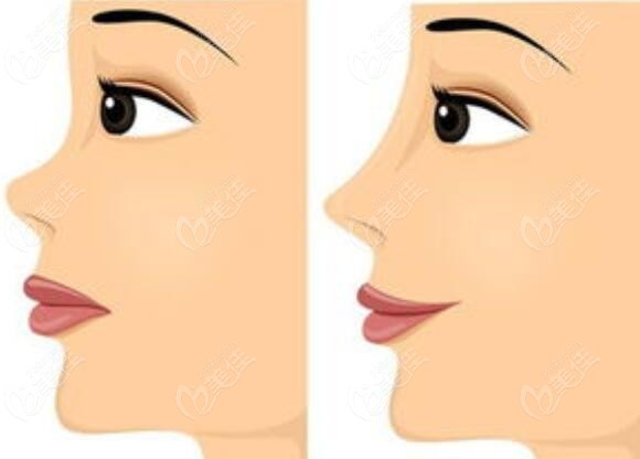FTop 10 Recommended Nose Reconstruction Surgeons in South Korea: Lee Byeong Min and Bai Yin Xiu for Natural-looking Results
