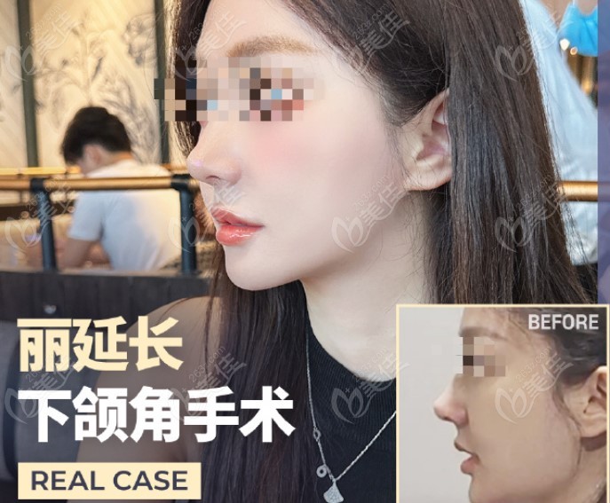 jaw angle osteotomy jaw angle osteotomy