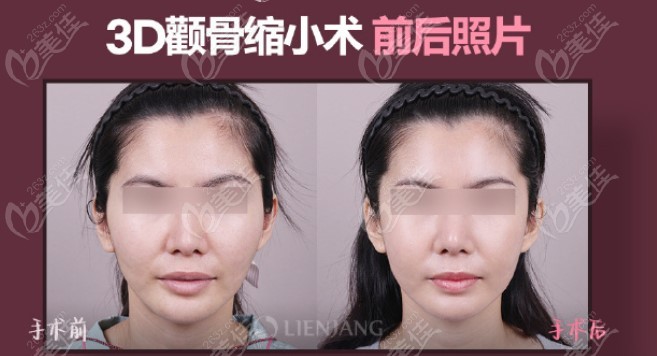 malar bone reduction malar bone reduction