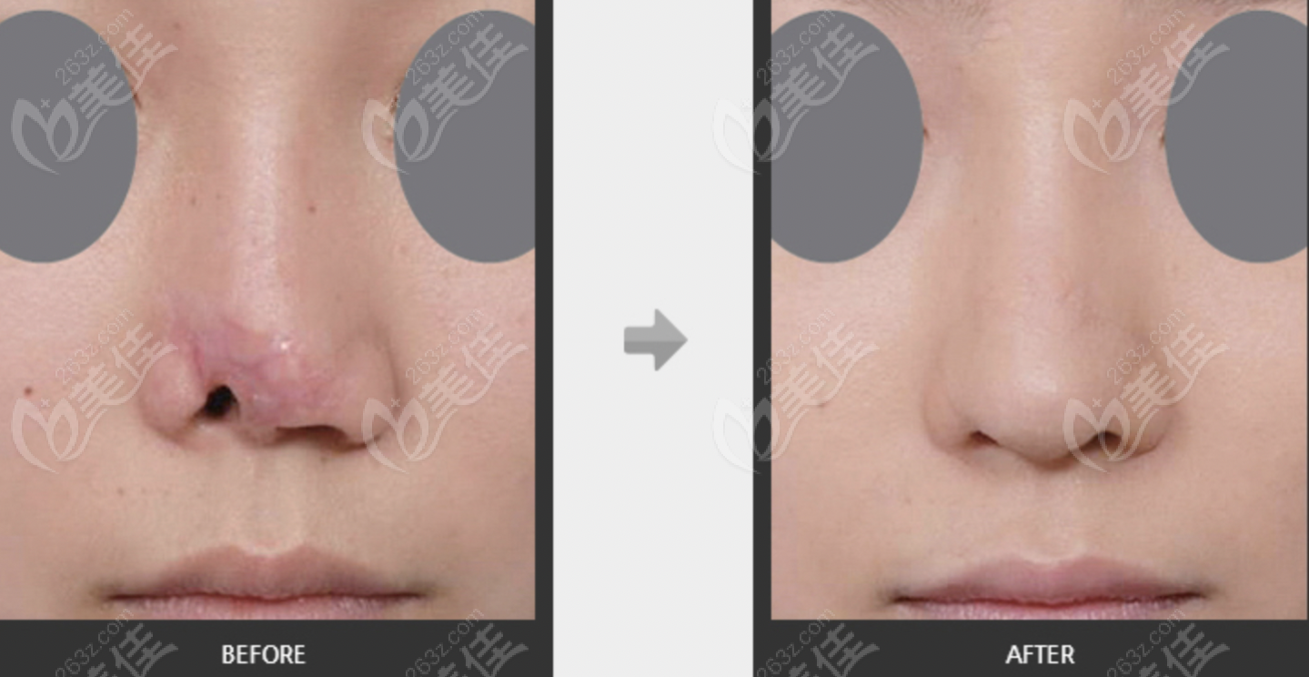FHow is Zheng Dongxue's Nose Job? Comparison Photos and Prices Done by South Korean Plastic Surgeon Zheng Dongxue