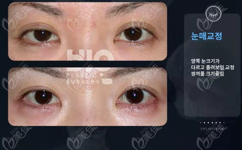 narrowing of wide double eyelids repair narrowing of wide double eyelids repair