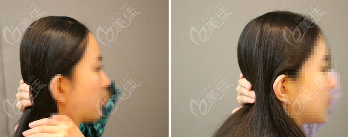 Before and after photos of posterior skull augmentation Before and after photos of posterior skull augmentation