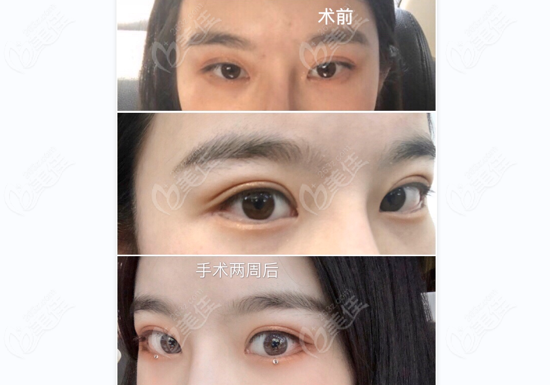 double eyelid repair at Pure Plastic Surgery double eyelid repair at Pure Plastic Surgery