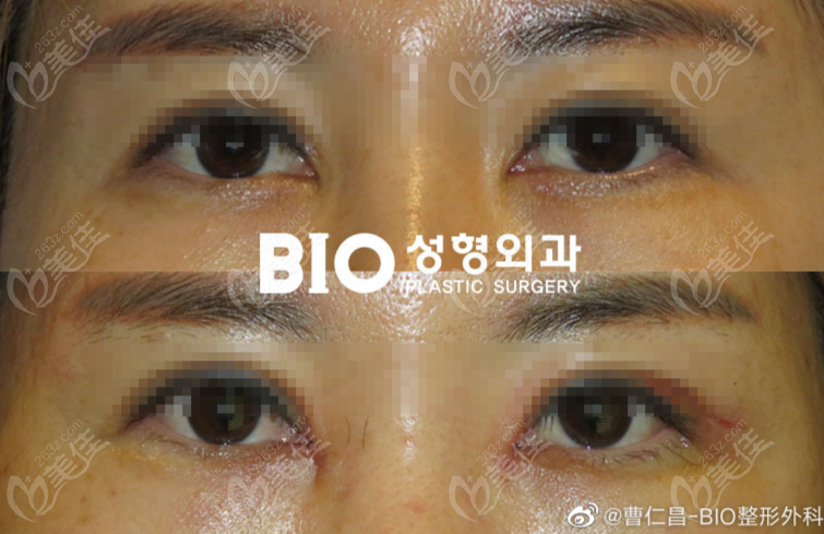 internal eye corner repair internal eye corner repair