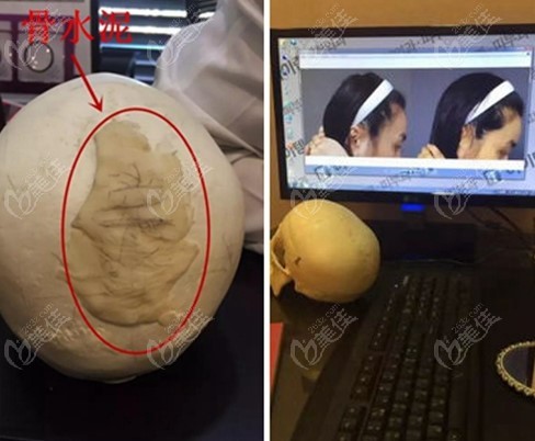 Is Jawgak Plastic Surgery's posterior skull augmentation risky? Is Jawgak Plastic Surgery's posterior skull augmentation risky?