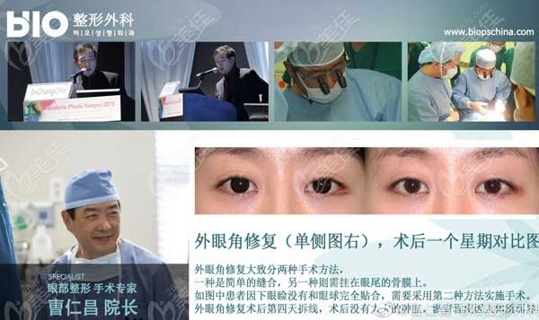 Cases of Cao Renchang's external eye corner repair Cases of Cao Renchang's external eye corner repair