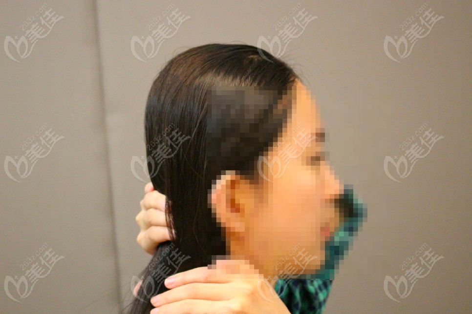 Posterior Skull Augmentation Posterior Skull Augmentation