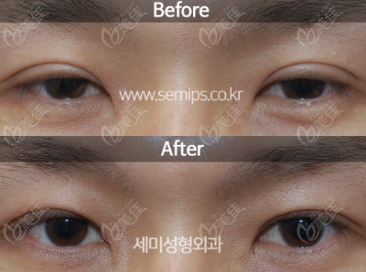 examples of eye repairs done by Director Park examples of eye repairs done by Director Park