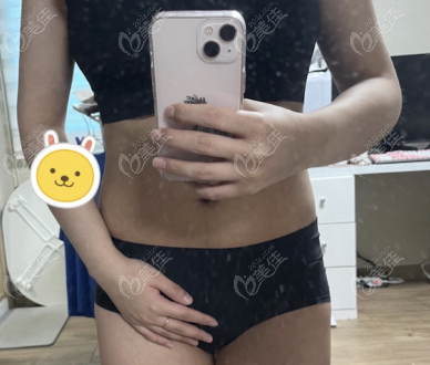 Abdominal liposuction case study at Qline Abdominal liposuction case study at Qline