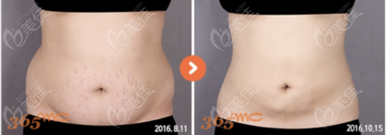Abdominal liposuction case study at 365mc Abdominal liposuction case study at 365mc
