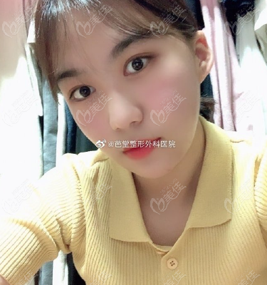 underwent double eyelid surgery underwent double eyelid surgery