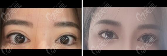 comparison photos of double eyelid repair surgeries comparison photos of double eyelid repair surgeries