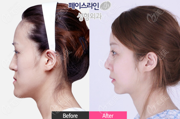 "sunken mouth" appearance. "sunken mouth" appearance.
