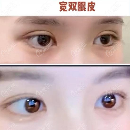 The width of the double eyelids is clearly visible