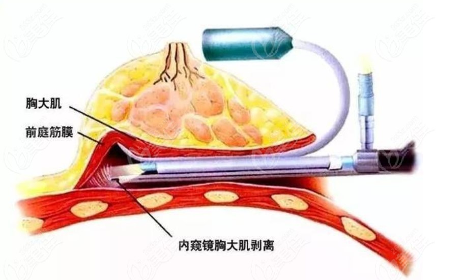 Advantages of Breast Augmentation at Migo Plastic Surgery