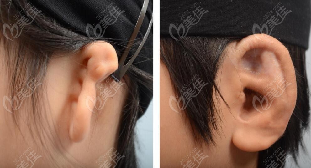 FHow is Profile Plastic Surgery for Ear Plastic Surgery? Dr. Lee Haoki's Expertise in Facial Ear Reconstruction