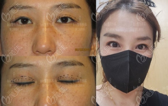 Examples of Cho Jae-chang's double eyelid repair surgery Examples of Cho Jae-chang's double eyelid repair surgery
