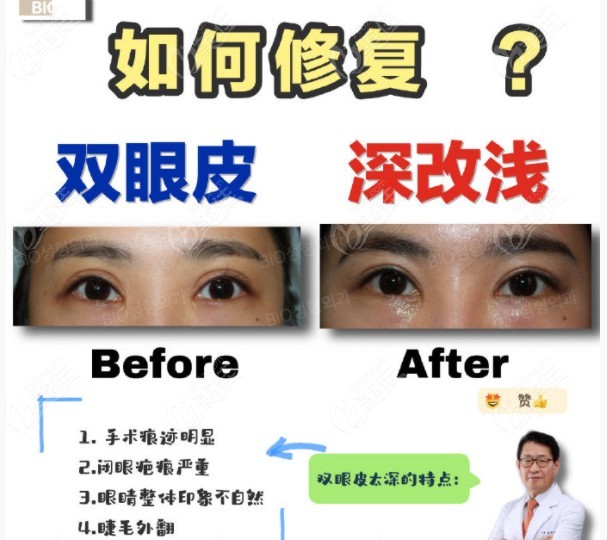 transforming deep double eyelids into shallow double eyelids transforming deep double eyelids into shallow double eyelids