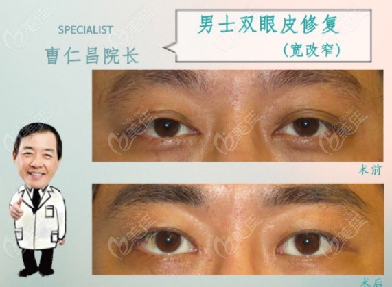 narrowing a wide double eyelid in a male patient narrowing a wide double eyelid in a male patient