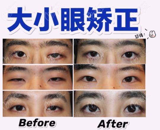orrecting asymmetric eyes orrecting asymmetric eyes