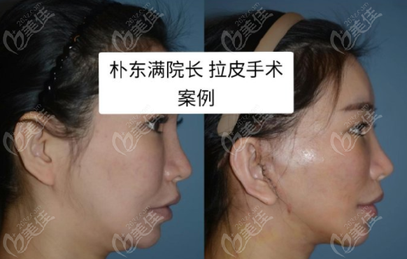 Facelift at Bio Plastic Surgery Facelift at Bio Plastic Surgery