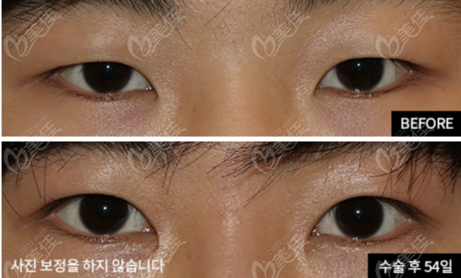 Male Eye Correction Male Eye Correction