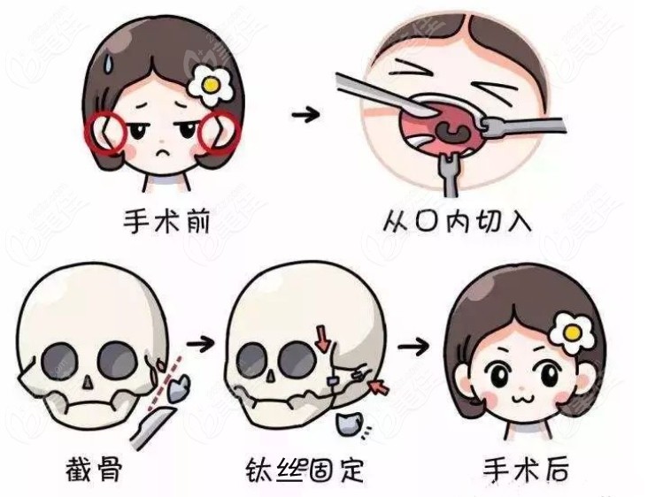 FThe Price of Cheekbone Reduction Surgery at Faceline Plastic Surgery is $7,000+, Director Lee Ensures a Natural and Non-sagging Result