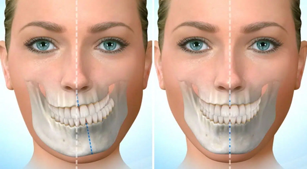 FTell You Double Jaw Surgery in Korea, Everything You Need To Know About It in Seoul