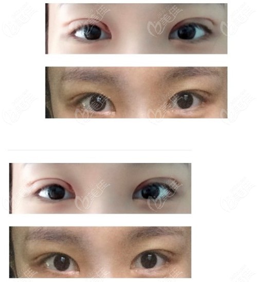 Asymmetrical double eyelid repair Asymmetrical double eyelid repair
